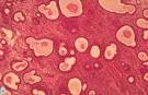 Femenina » <b>Hiperplasia endometrial</b>