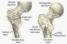 هشاشة العظام مرض صامت فاحذري منه Images?q=tbn:ANd9GcSjW8DUTPncAwQtYmxqbTD425nNMmD00BpJV5pYo0V6O54NooDFcA