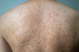 Image result for tinea corporis