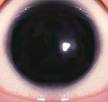 <b>Aniridia</b>