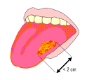 Cancer de la <b>langue</b> - T1