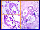 <b>Enfermedad fibroquística</b>