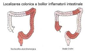 Image result for boala crohn si schizofrenie paranoida