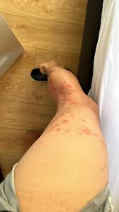 Image result for bed bug bites