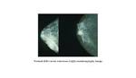 http://www.consumersresearchcncl.org/Healthcare/Oncologists/images/Mammo_breast_cancer.jpg