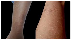 Attēlu rezultāti vaicājumam “Diderma umbilicatum young”