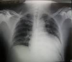 File:Rx Torax <b>Cardiomegalia</b>.