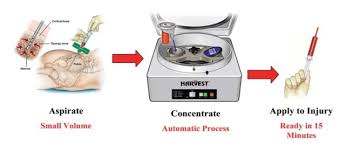 Image result for BMAC