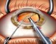 <b>Cataract Extraction</b> and Lens