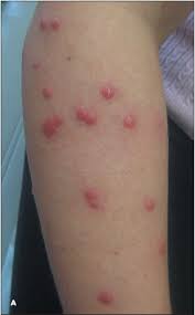 Image result for bed bug bites
