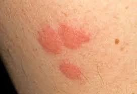 Image result for bed bug bites