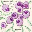What is <b>multiple myeloma</b>?