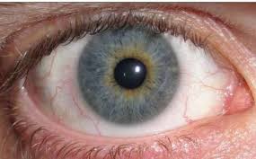 Kuvahaun tulos haulle Kayser-Fleischer