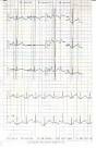 <b>Romano</b>-<b>Ward Syndrome</b> - Case