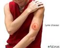 Pictures for Colorado tick fever