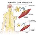 Amyotrophic Lateral Sclerosis (