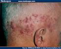Hair Diseases