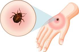 Image result for bed bug bites