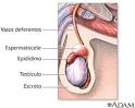 <b>Espermatocele</b>