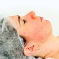 ©iStockphoto.com/Amanda Rohde - what-causes-red-blotches-on-face-1