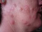 Bed Bug Bites on Woman's Face