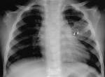 Mesenchymal <b>Hamartoma</b> of the Chest Wall: Radiologic Manifestations
