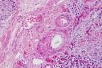 File:<b>Arteriolosclerosis</b>