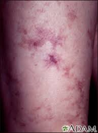 Attēlu rezultāti vaicājumam “Reticularia sp.”