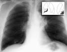 Right lower lobe <b>atelectasis</b>