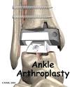 A Patient's Guide to Artificial Joint Replacement of the Ankle