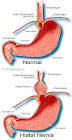 Gastroesophageal Reflux Disease (GERD) Symptoms, Causes, Treatment ...