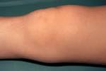 <b>Juvenile Rheumatoid Arthritis</b> Juvenile Rheumatoid Arthritis