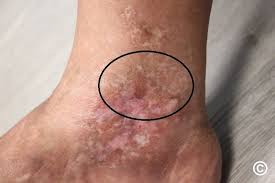 Attēlu rezultāti vaicājumam “Reticularia sp.”