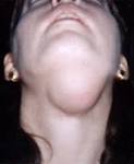 Plunging <b>ranula</b> in a