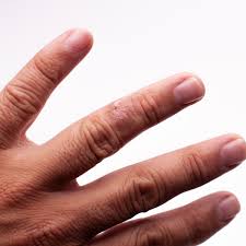 Attēlu rezultāti vaicājumam “Scleroderma”