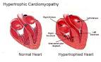 ventricular hypertrophy