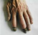 <b>Gangrene</b> in Fingertips by