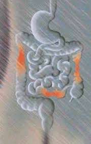 Image result for boala crohn si schizofrenie paranoida