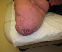 Attēlu rezultāti vaicājumam “Pemphigus borealis”