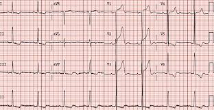 Image result for  ^ L V [ h    