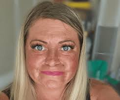 Attēlu rezultāti vaicājumam “Scleroderma”