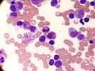 <b>Histiocytes</b> with cytoplasmic