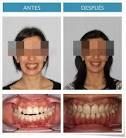 caso de <b>mordida abierta</b>