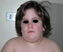 Prader Willi syndrome