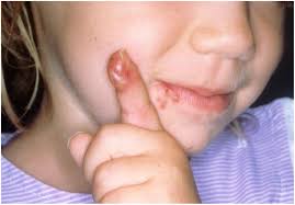 Attēlu rezultāti vaicājumam “Diderma simplex sessile”