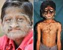 werewolf Werewolf Syndrome