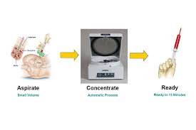 Image result for BMAC