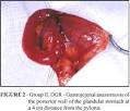 <b>duodenogastric reflux</b>