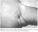 Sao Paulo Medical Journal - Transsphinctericanorectal ...