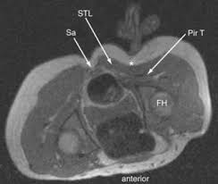 Attēlu rezultāti vaicājumam “Cribraria piriformis young”